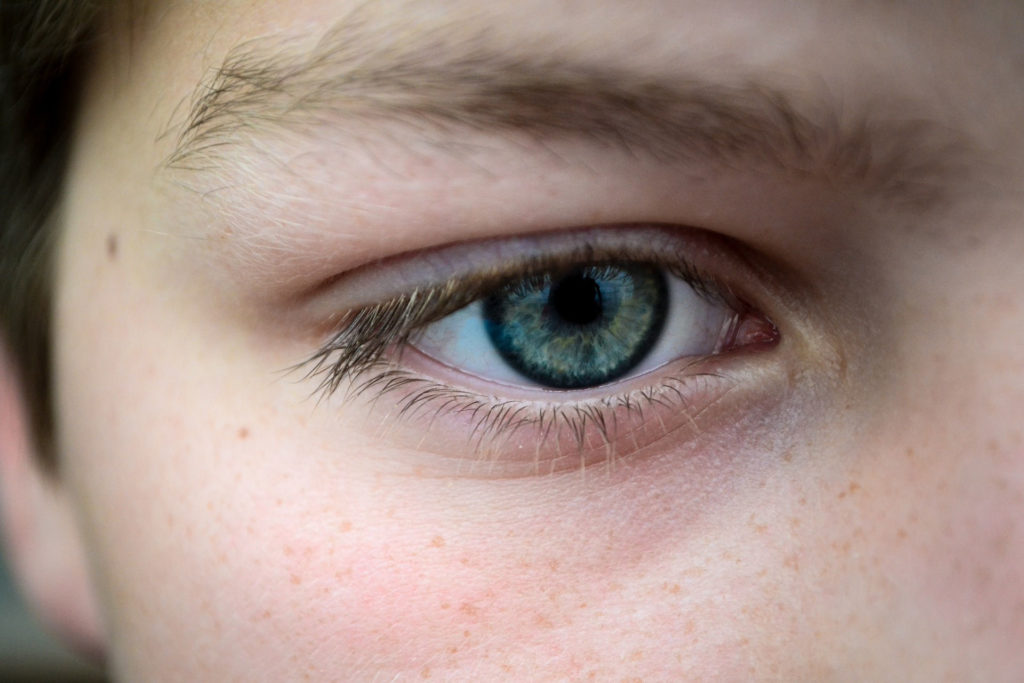 ojeras